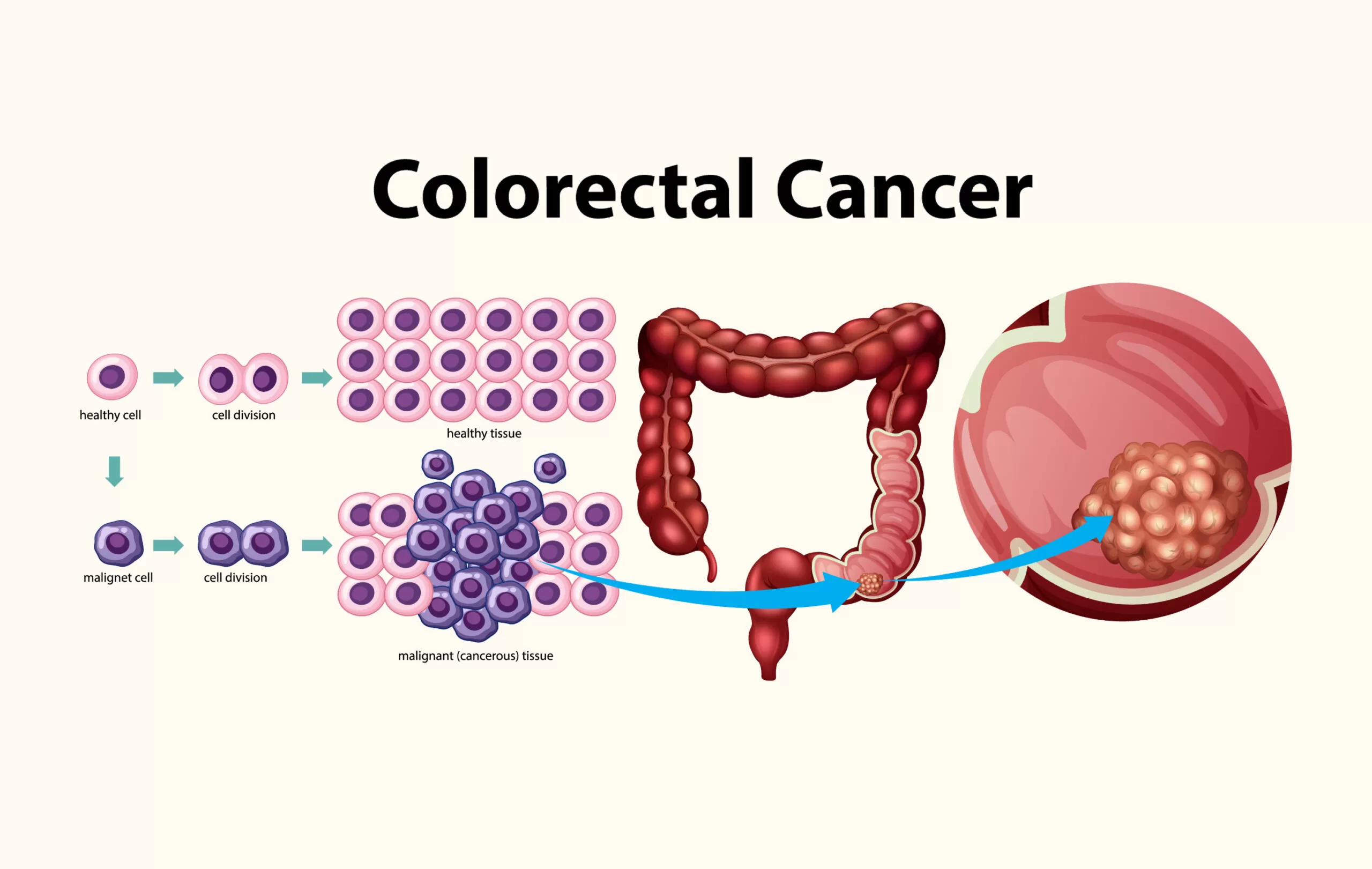 سرطان روده بزرگ