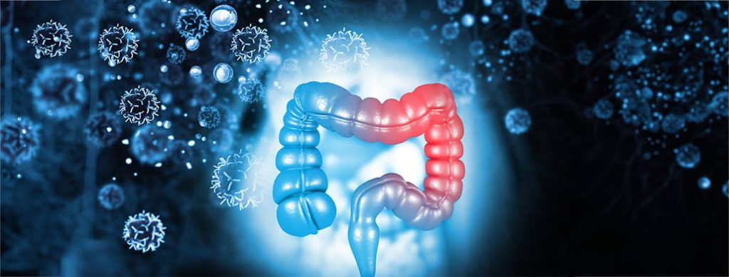 سرطان روده بزرگ